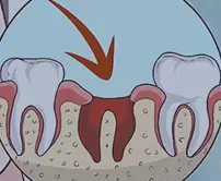 牙髓炎治療介紹